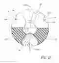 Fig. 20 - Medical valve with fluid escape space