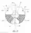 Fig. 20 - Medical valve and method of use