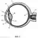 Fig. 02 - Liquid jet for glaucoma treatment