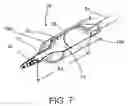 Fig. 08 - Liquid jet for glaucoma treatment