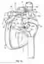 Fig. 12 - Methods and devices for ablation