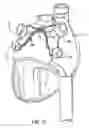 Fig. 13 - Methods and devices for ablation