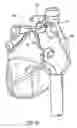Fig. 21 - Methods and devices for ablation