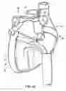Fig. 34 - Methods and devices for ablation