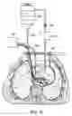 Fig. 61 - Methods and devices for ablation