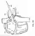 Fig. 81 - Methods and devices for ablation