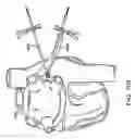 Fig. 84 - Methods and devices for ablation