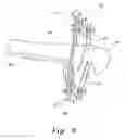 Fig. 07 - Method and apparatus for external fixation of bone fractures