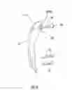 Fig. 07 - Intramedullary interlocking fixation devices for the distal radius