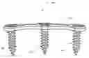 Fig. 01 - Orthopedic plate system and method for using the same