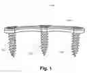 Fig. 02 - Orthopedic plate system and method for using the same