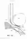 Fig. 52 - Surgical file system with fluid system