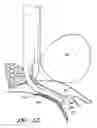 Fig. 53 - Surgical file instrument