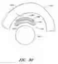 Fig. 84 - Surgical file instrument