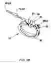 Fig. 04 - Gastric band insertion instrument