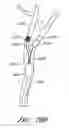 Fig. 48 - Method and apparatuses for treating an intravascular occlusion