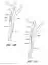 Fig. 49 - Method and apparatuses for treating an intravascular occlusion