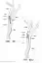 Fig. 52 - Method and apparatuses for treating an intravascular occlusion