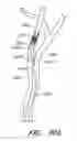 Fig. 55 - Method and apparatuses for treating an intravascular occlusion
