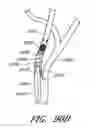 Fig. 56 - Method and apparatuses for treating an intravascular occlusion