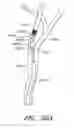 Fig. 59 - Method and apparatuses for treating an intravascular occlusion