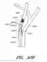 Fig. 60 - Method and apparatuses for treating an intravascular occlusion
