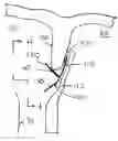 Fig. 01 - Remote body tissue engaging methods and apparatus