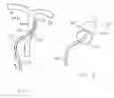 Fig. 04 - Remote body tissue engaging methods and apparatus