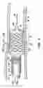 Fig. 06 - Stent deployment systems and methods