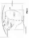 Fig. 06 - Geometry and material for use in high strength, high flexibility, controlled recoil drug eluting stents