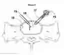 Fig. 04 - Materials, devices, and methods for in-situ formation of composite intervertebral implants