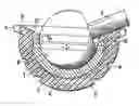 Fig. 01 - Implant and articular prosthesis comprising said implant