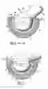 Fig. 02 - Implant and articular prosthesis comprising said implant
