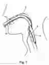 Fig. 11 - Laryngeal mask and a method manufacturing same