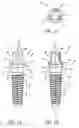 Fig. 02 - Dental implant system