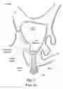 Fig. 02 - Dental implant system and method