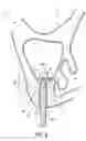 Fig. 09 - Dental implant system and method