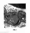 Fig. 02 - Methods of assessing endothelial dysfunction using acute transient responses following fat administration