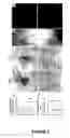 Fig. 11 - Methods of treating neurological diseases by regulating migration of neuroblasts in the adult nervous system with tenascin-R