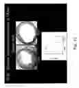 Fig. 16 - G-type peptides and other agents to ameliorate atherosclerosis and other pathologies