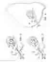 Fig. 03 - Temporary catheter for biopsy site tissue fixation