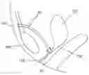 Fig. 01 - Apparatus and method for treating female urinary incontinence