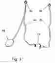 Fig. 10 - Apparatus and method for treating female urinary incontinence