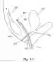 Fig. 12 - Apparatus and method for treating female urinary incontinence