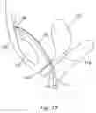 Fig. 13 - Apparatus and method for treating female urinary incontinence