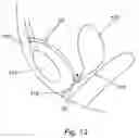 Fig. 14 - Apparatus and method for treating female urinary incontinence
