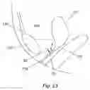 Fig. 24 - Apparatus and method for treating female urinary incontinence