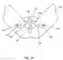 Fig. 25 - Apparatus and method for treating female urinary incontinence