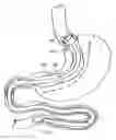 Fig. 01 - Attachment system for transmural attachment at the gastroesophageal junction