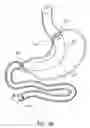 Fig. 03 - Attachment system for transmural attachment at the gastroesophageal junction